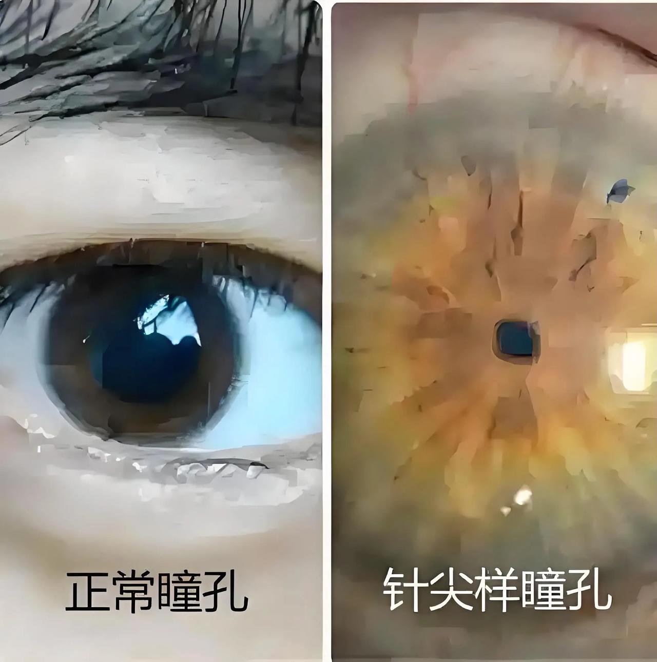 针尖样瞳孔！🌚虽有点吓人，但您想了解！人的瞳孔是个圆圈，就像照相机的
