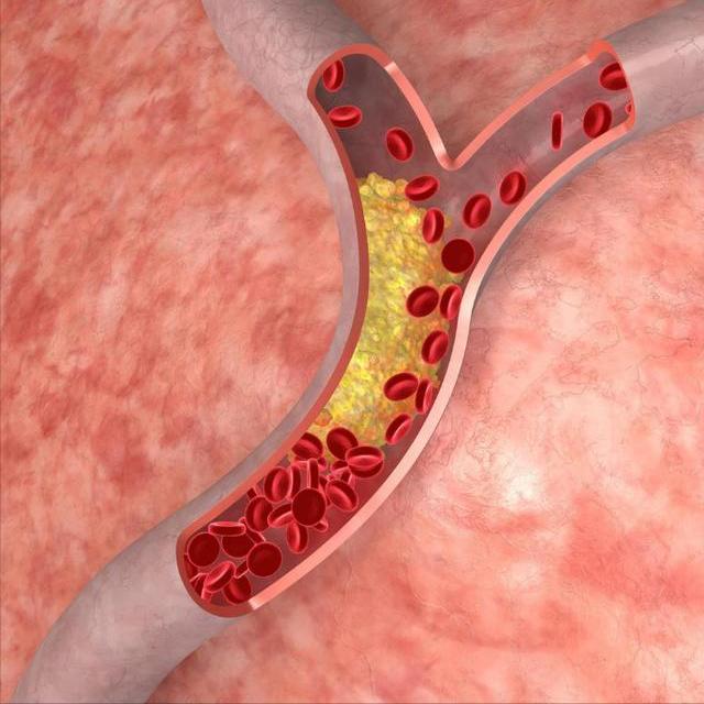 血管堵塞无小事，三大危害记心里 血管就像我们身体里的生命通道，一旦发生堵塞，