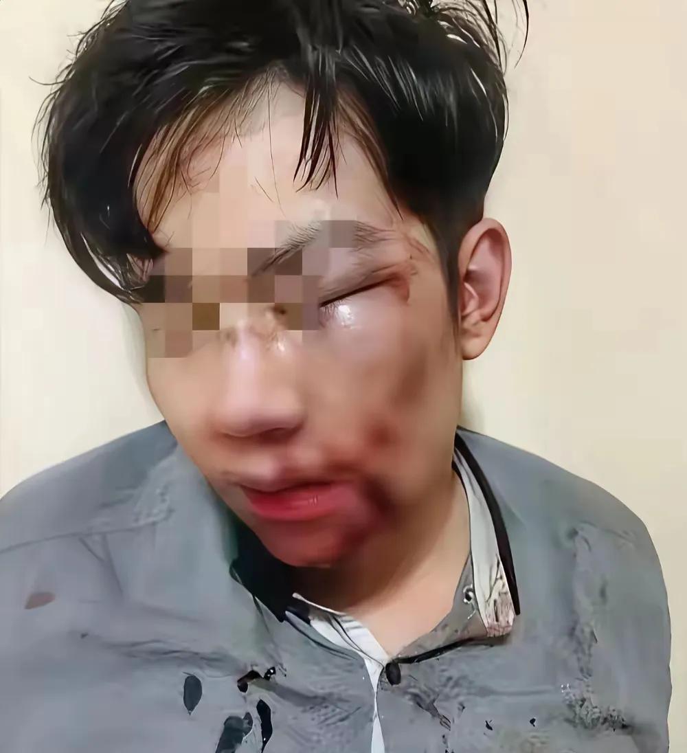 中秋远嫁妻子回娘家买礼物，就因为多买了点，居然被丈夫打得骨折住院！这事传到妻子三