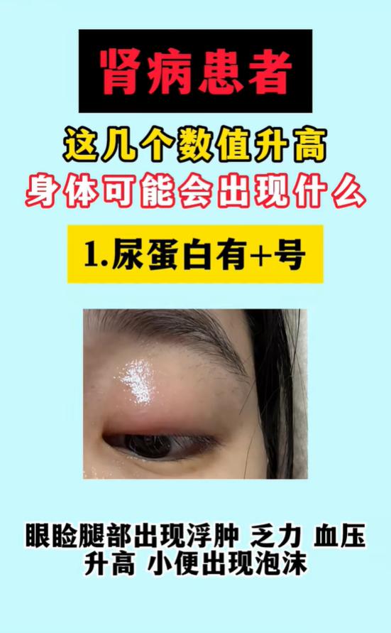 肾病化验单看懂了吗？尿蛋白、潜血、肌酐升高对应哪些身体表现