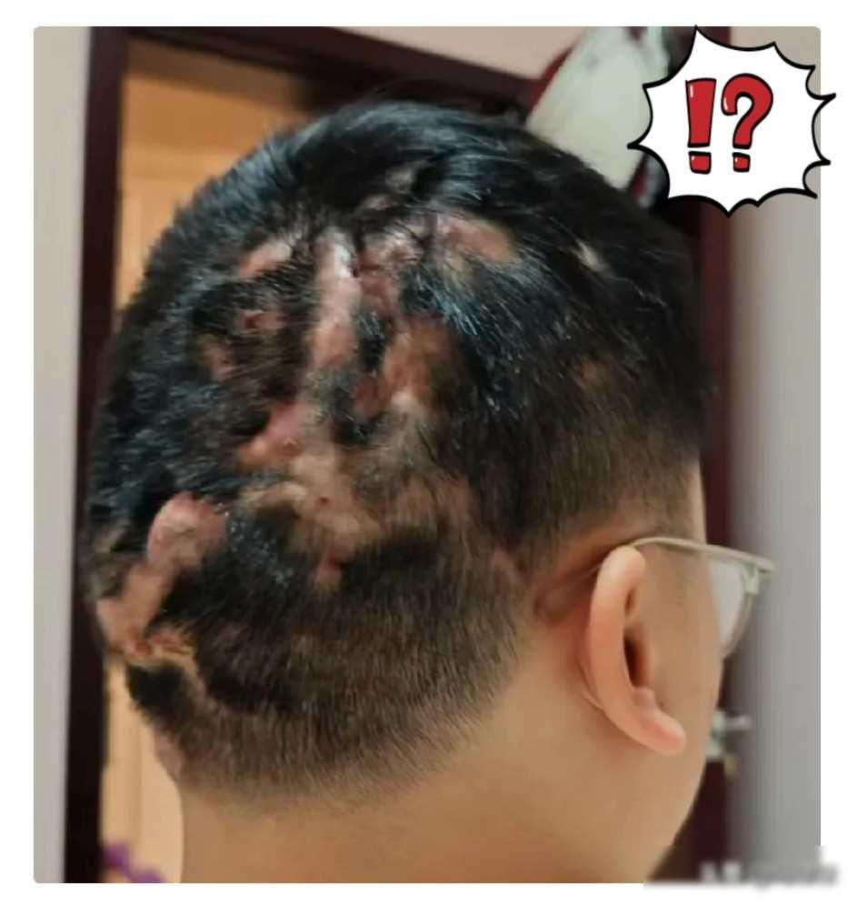 同事儿子21岁就满头脓疮，同事带儿子跑了大半个中国医院，每个医院的医生检查出的结