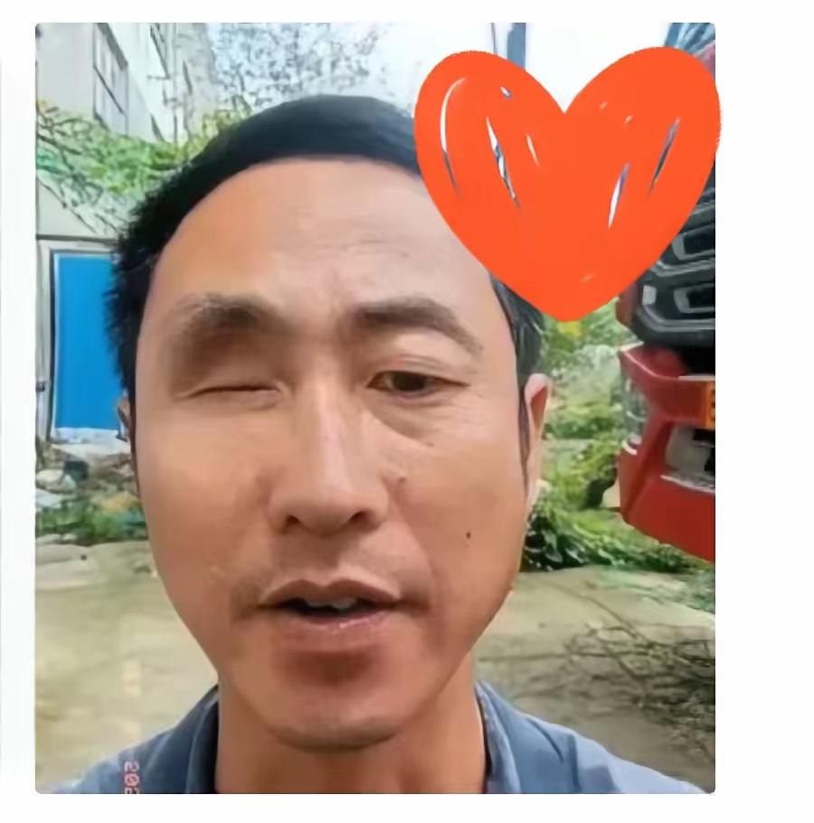 一只眼睛没了，去办残疾证，工作人员说办不了，因为你另一只眼好使，不影响正常生活。
