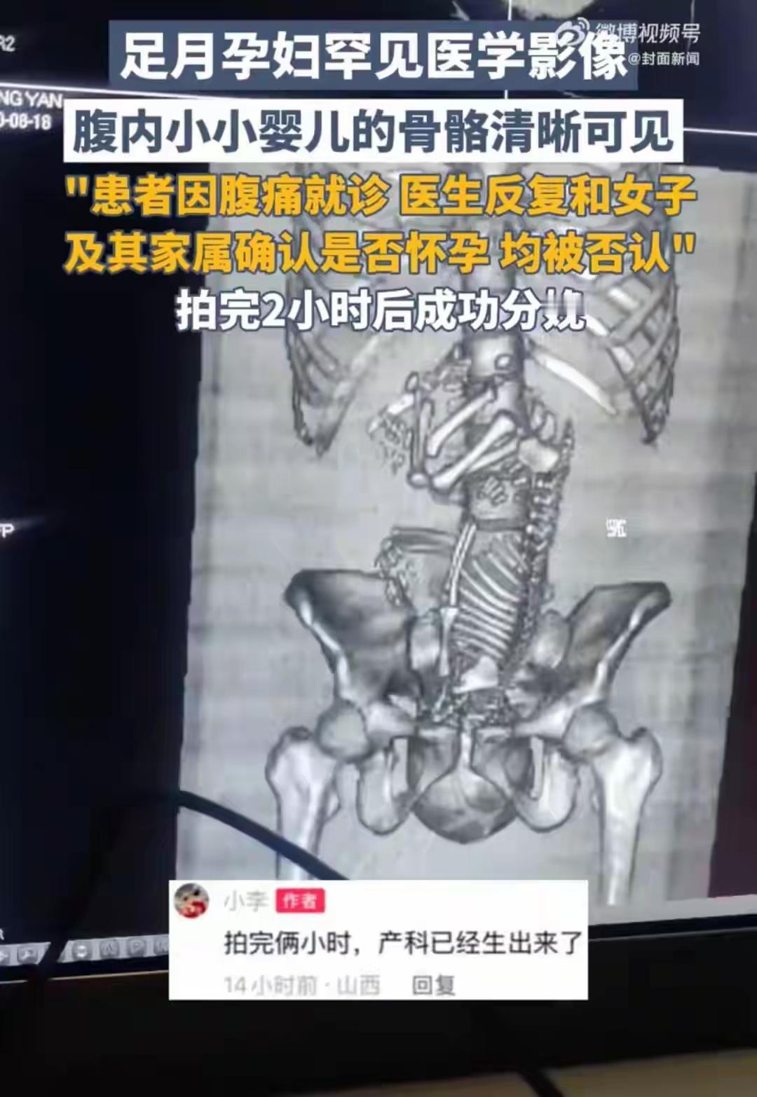 太糊涂了！19岁女孩生产在即，却不知道自己怀孕了！女孩因腹痛难忍去了急诊，影像