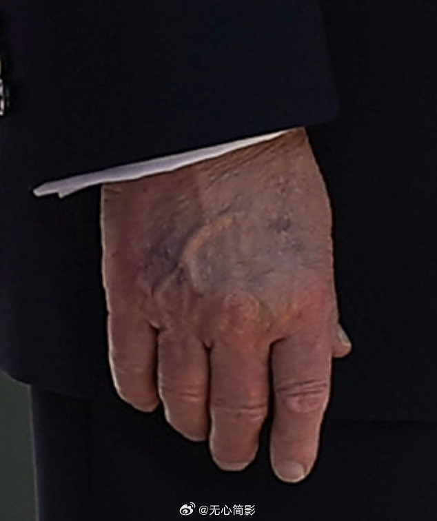 今天在白宫复活节滚彩蛋活动中，特朗普右手背明显变色。看起来非常不健康。海外新鲜事