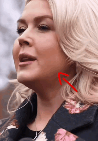 美女的嘴角也起泡了，是说话说多了？还是着急上火了？看来二者皆有之！实实在在说，白