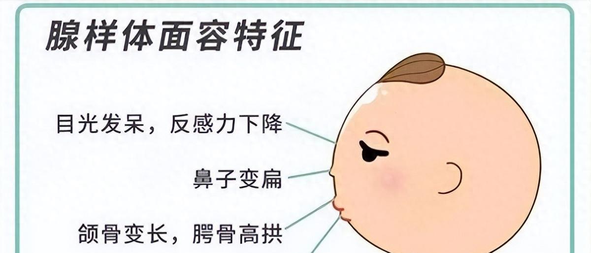 医生：孩子必须动刀！80%父母还不知道第三条路鼻炎拖久了，腺样体长期肿大，孩