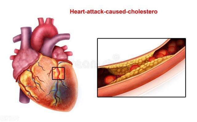 平时血脂高, 一般多久可引发冠心病?