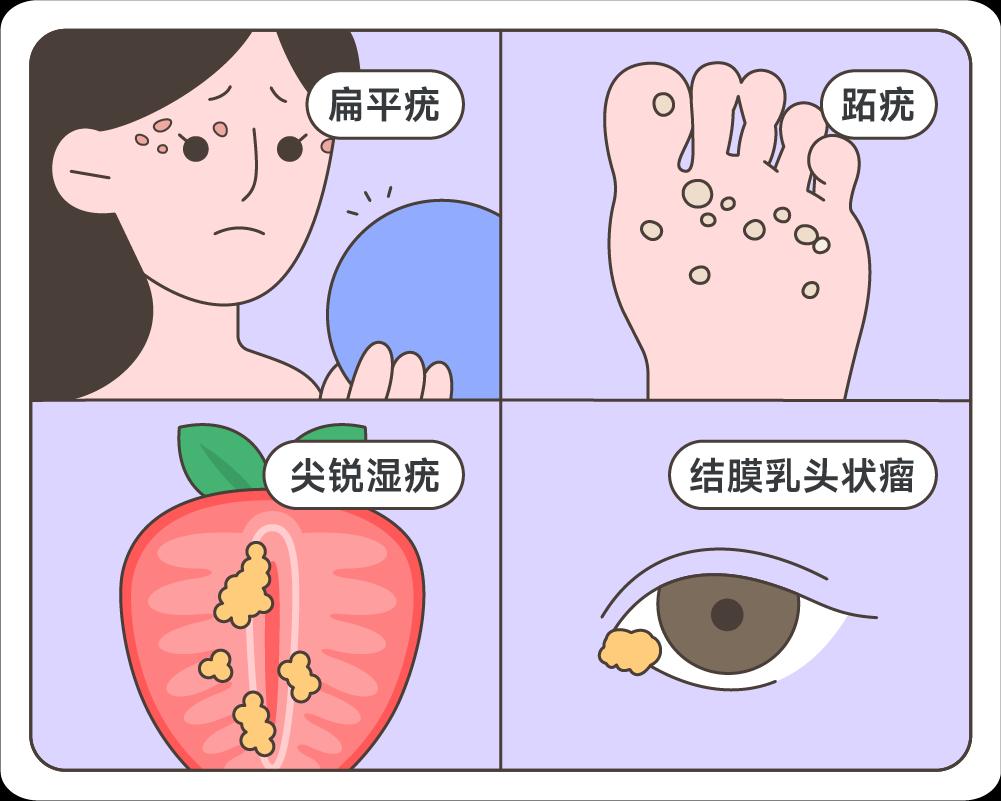 感染HPV后，外貌最明显的5个变化，女性千万别忽视！很多患者来找我，一进门就