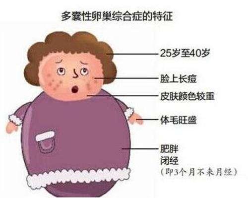 痤疮、多毛、肥胖、月经稀发的女性, 要注意了, 可能是病