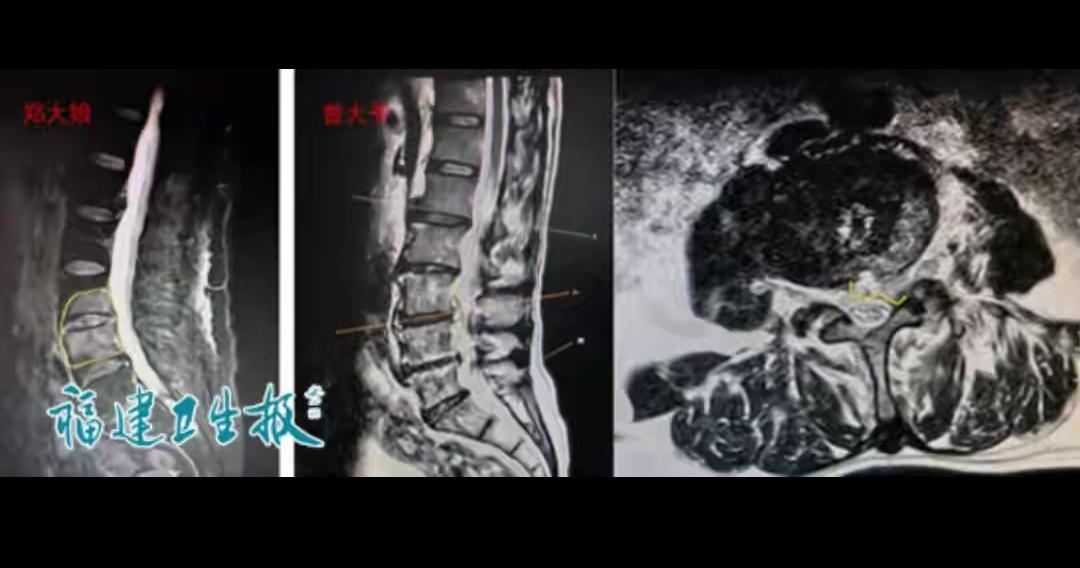 太可怕！别再把腰痛不当回事，不起眼的习惯，正在悄悄啃食你的骨头！福建一对夫