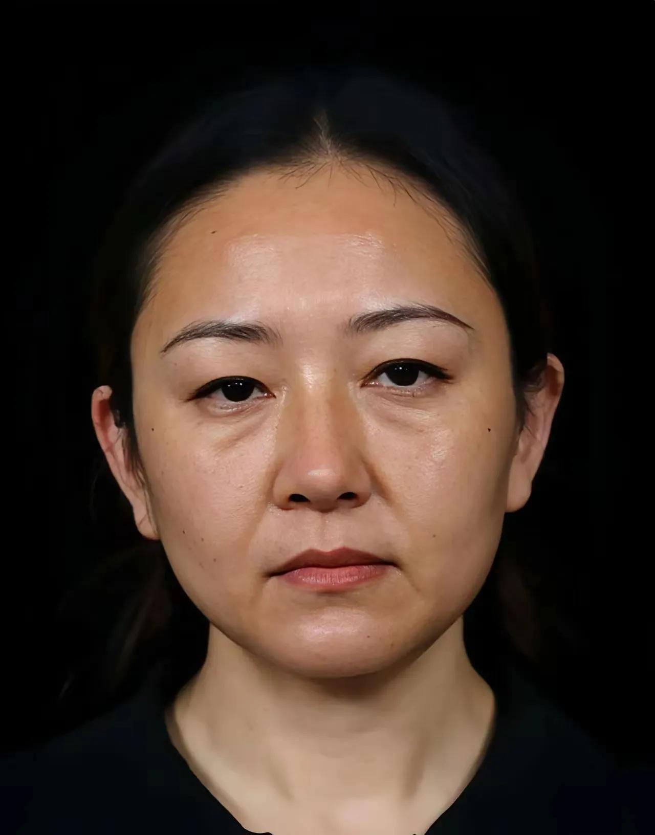 这个脸部提升做的非常成功最起码足足年轻了二十岁都有吧