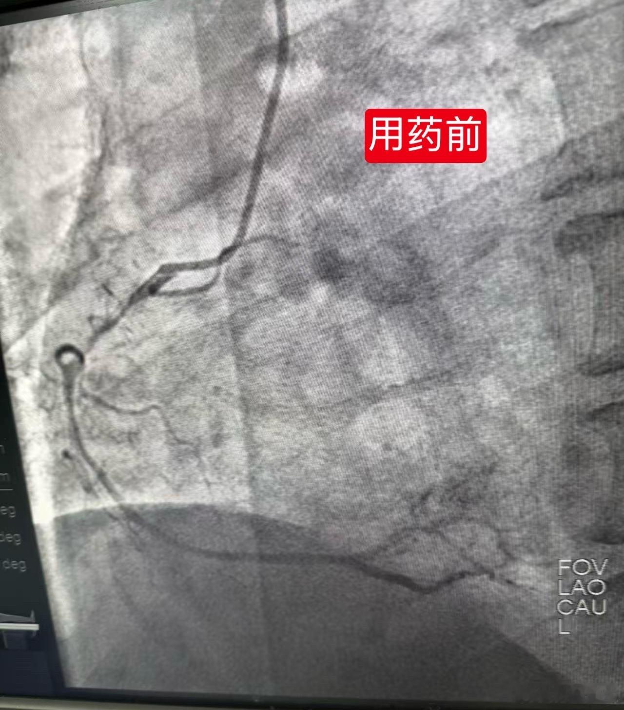 50岁男性，胸痛，看心电图像下壁心梗，造影提示右冠严重狭窄，给予硝酸甘油后狭窄消