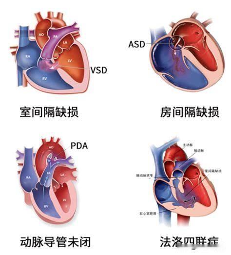 今天在抖音上看到一个科普视频，讲的是一个房间隔缺损已经丧失手术机会的患者，讲的是