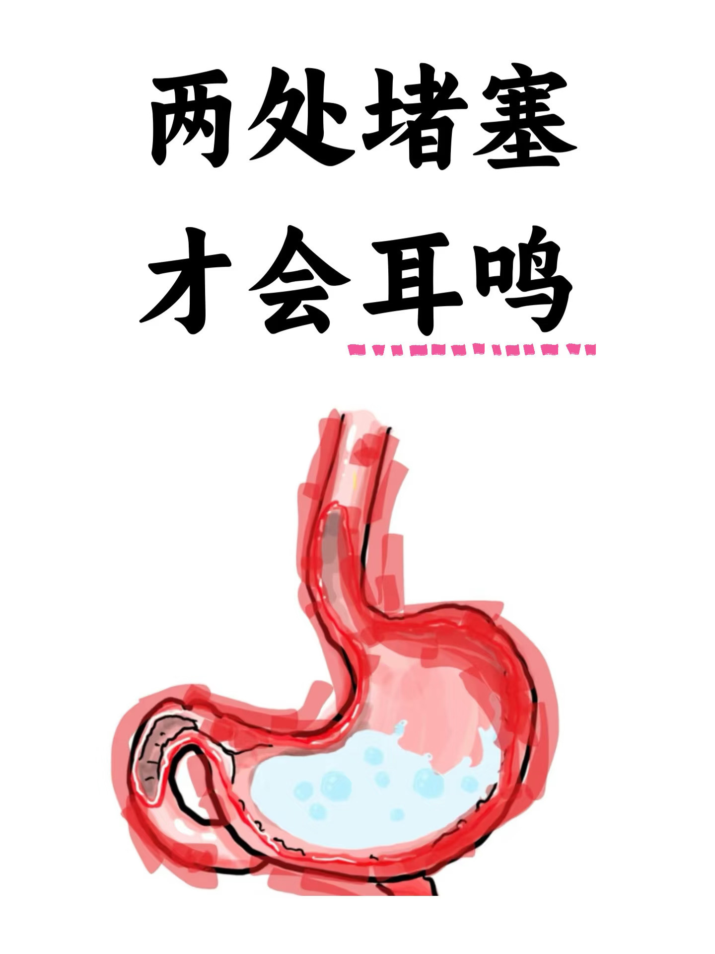 耳鸣并非单纯的耳部病变，除了肾精亏虚、耳窍失养等常见原因，脏腑气机郁滞...