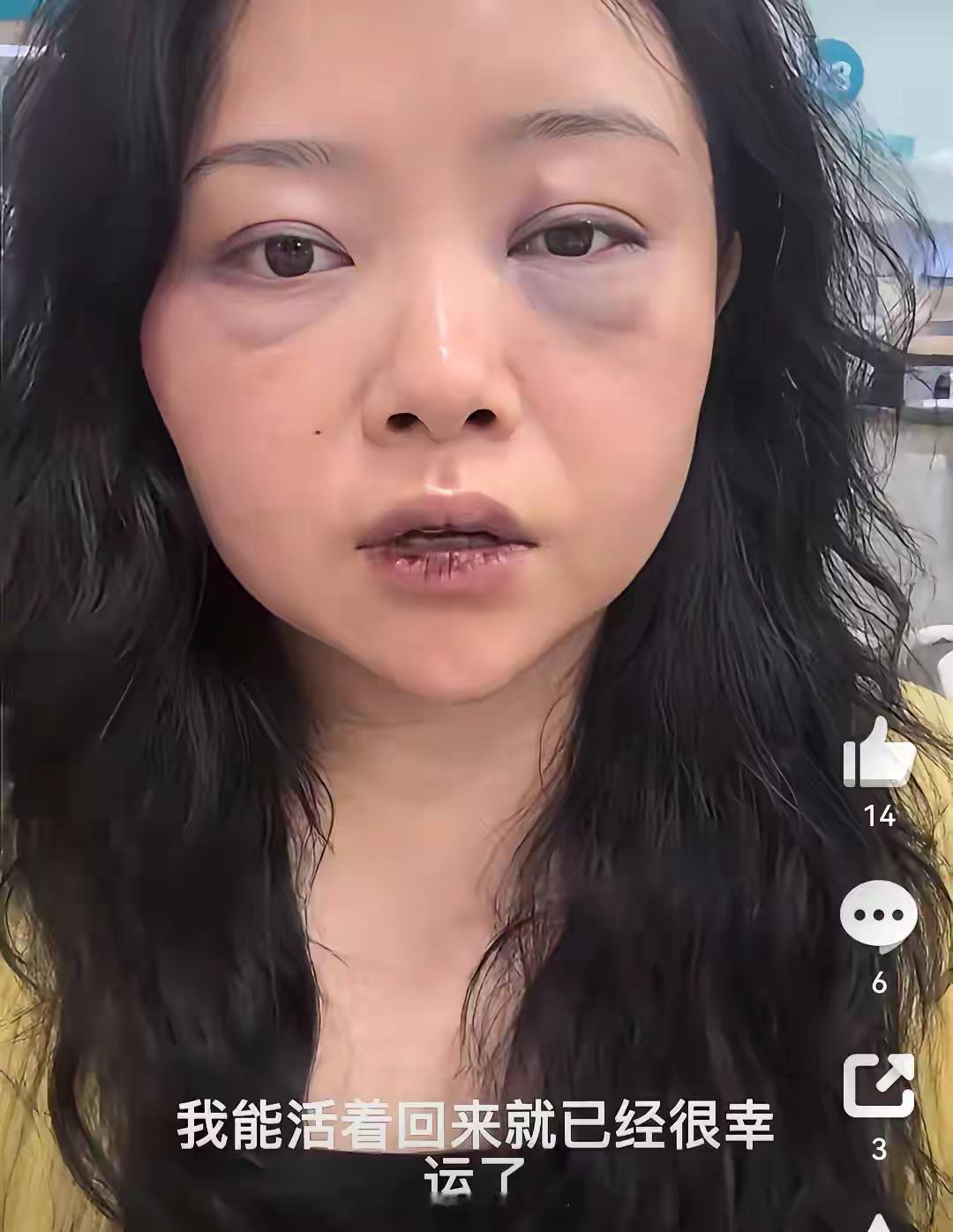 浑身是伤的女博主，吐槽自己被外国男友以“爱情+国外合法高薪”为由骗到国外，手机被