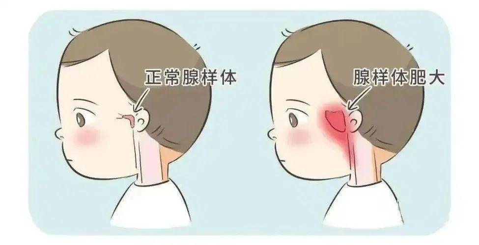 孩子鼻炎、腺样体肥大，这3种“偷阳气”的食物尽量不吃，生寒湿伤脾胃，越吃鼻子越堵