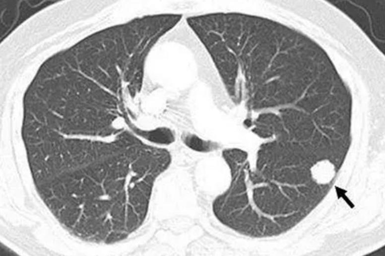 大几万切除的肺结节卷土重来，中医几味常见药铲除病根，无条件分享“大夫，我花几
