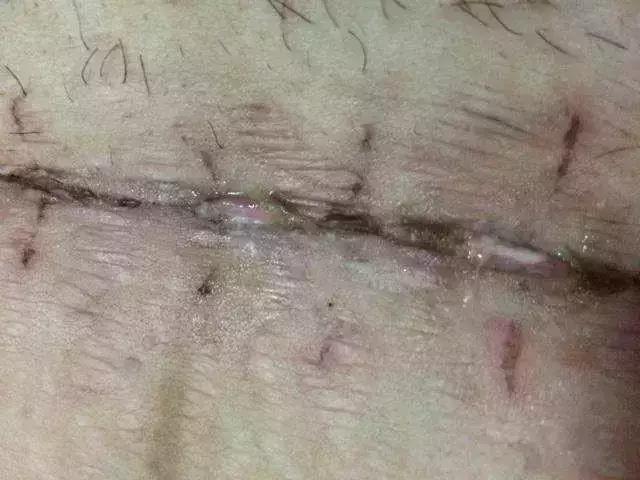 剖腹产18天后, 伤口突然崩裂流血水, 医生怒斥老公“禽兽不如”