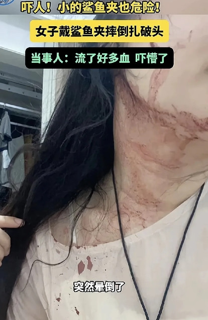 太吓人了！女子过生日，梳了一个精美的头型，带着一个小小的鲨鱼夹，谁曾想，突然贫血