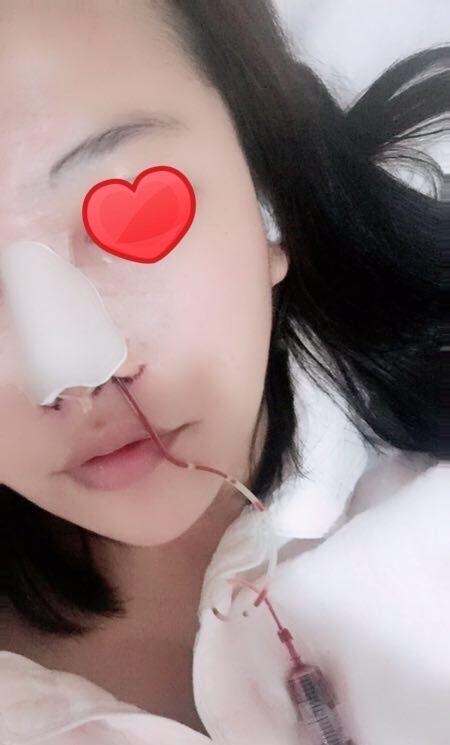 三月份做的自体软骨隆鼻+鼻综合, 给你们看看怎样