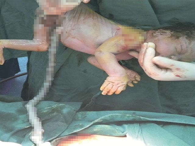 孕妇怀孕38周喘不过气来, 医生剖开肚子后, 宝宝脖子被脐带缠了4圈