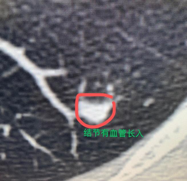 我在门诊坐诊的时候，总碰到患者拿着肺结节检查报告追着问：“乔医生，你帮我瞧瞧，我