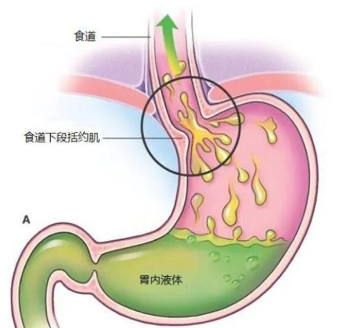 很多朋友都有反流性食管炎的困扰，经常反酸、烧心、胸口闷胀，最关心的问题就是这个病