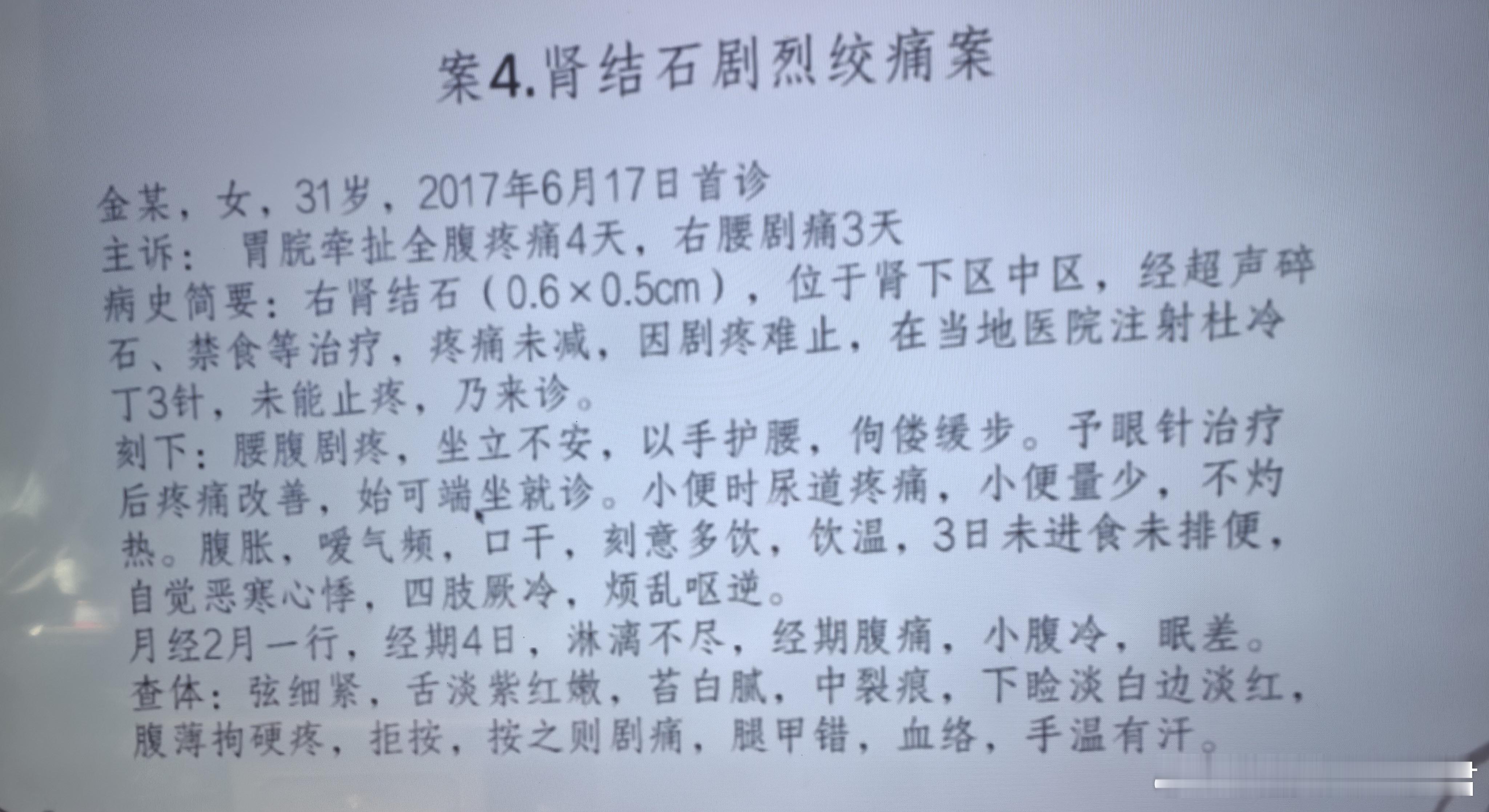 这么严重的肾结石剧痛，一般剂量的四逆散15付，结石就排出来了，许老师的功力我看三
