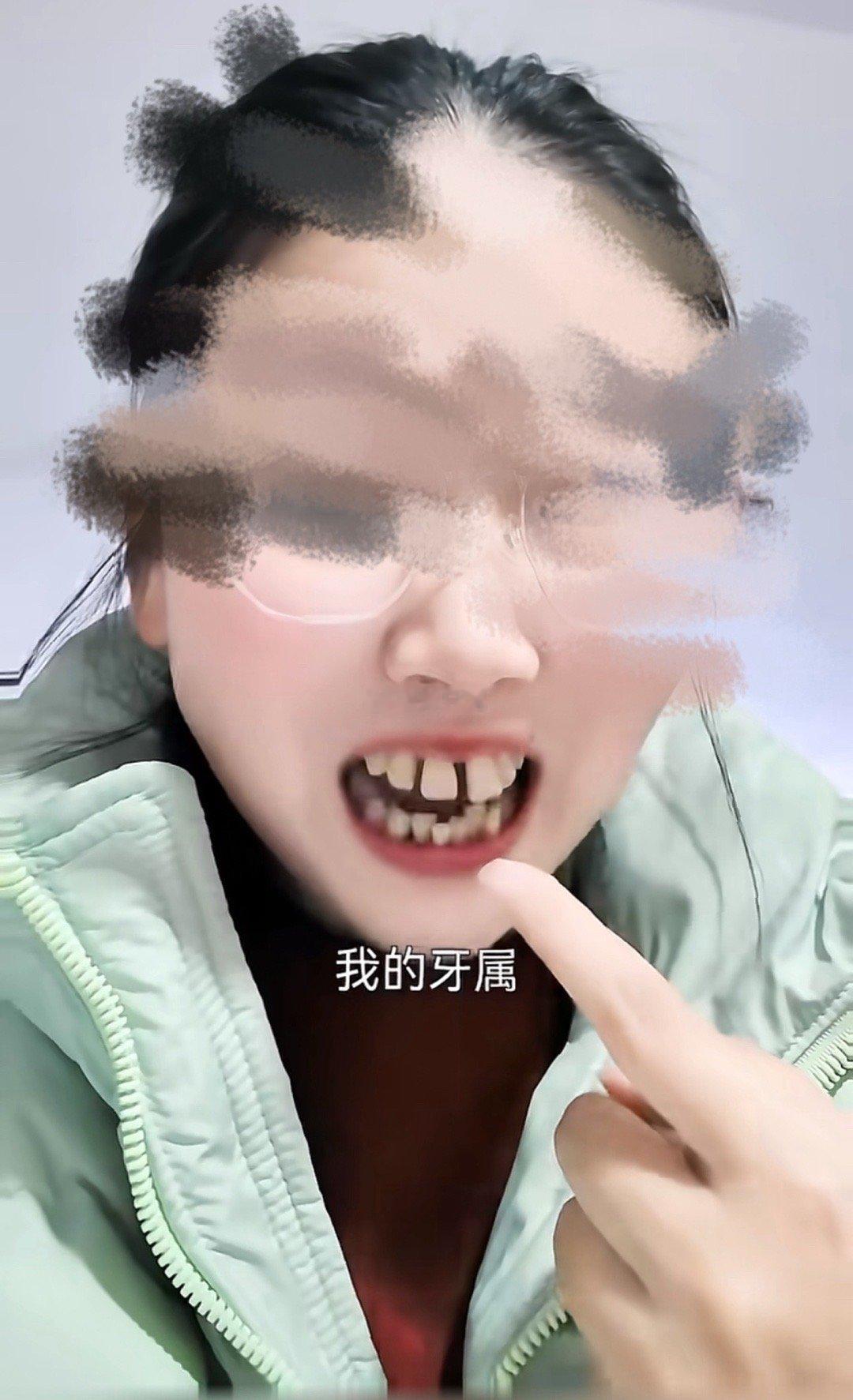 孕前后对比孕激素导致的重度牙周病想恢复到以前要花十几万+至少五年时间已经影