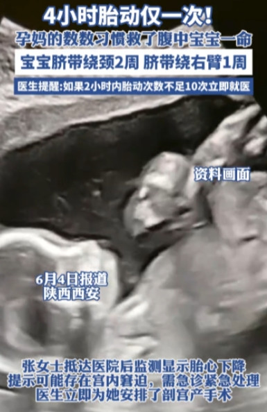 “电视剧都不敢这么演！”陕西，38周的张女士下午突然发现宝宝四个钟头只动了一下，