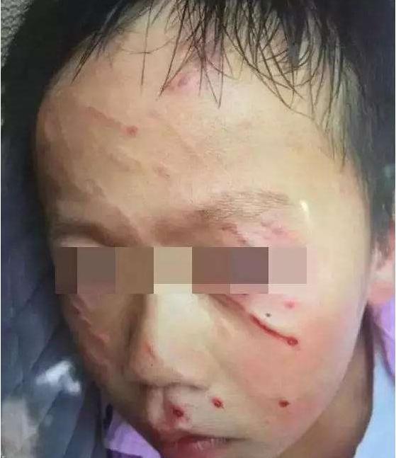 2017年武汉两个男孩在学校里打架，一男孩被打破了相，老师看着小强脸上横七竖八的