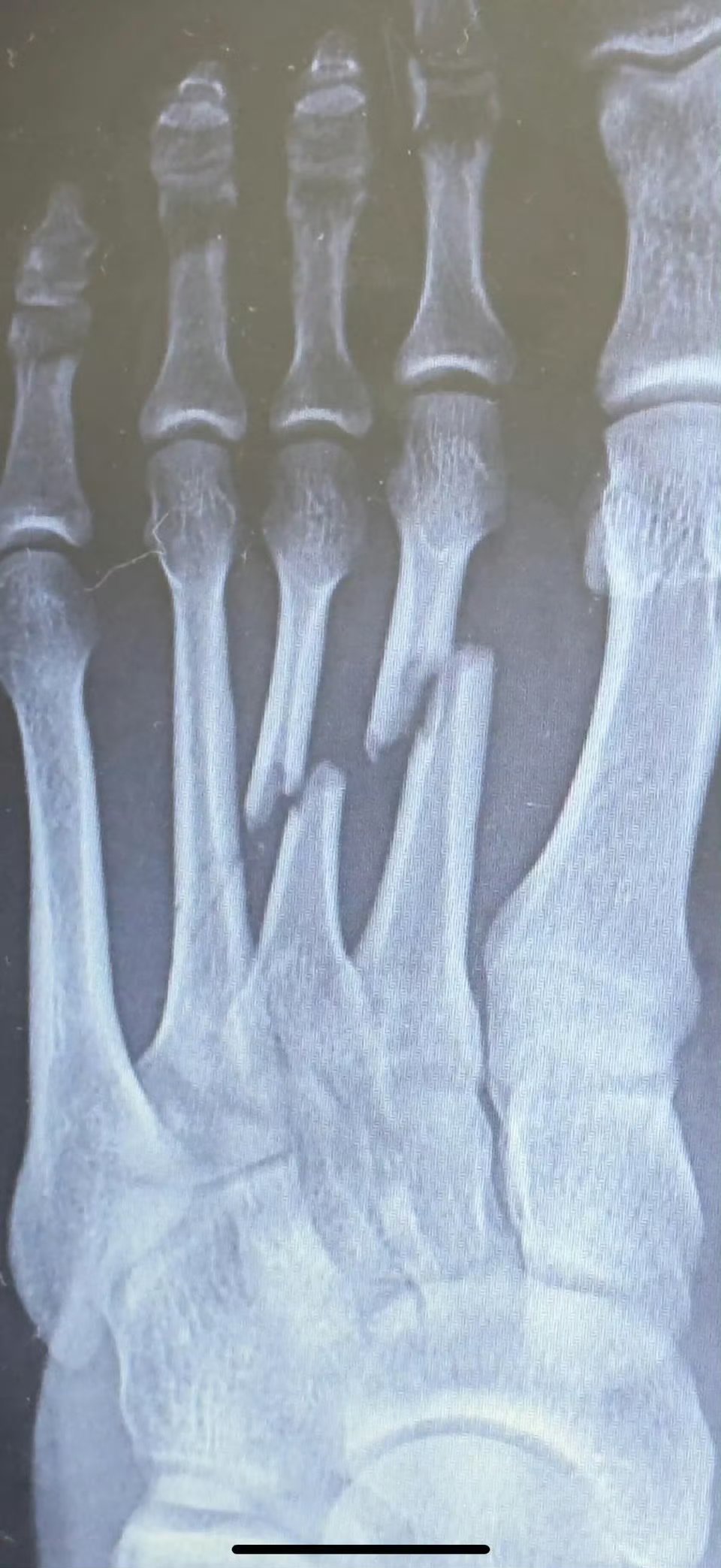 网友：脚砸伤了，没管！一年后自愈了……