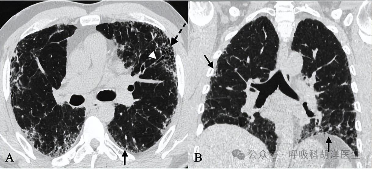 肺里的“海绵”变硬后还突然“闹罢工”？肺纤维化一旦加重，就像呼吸路上的“