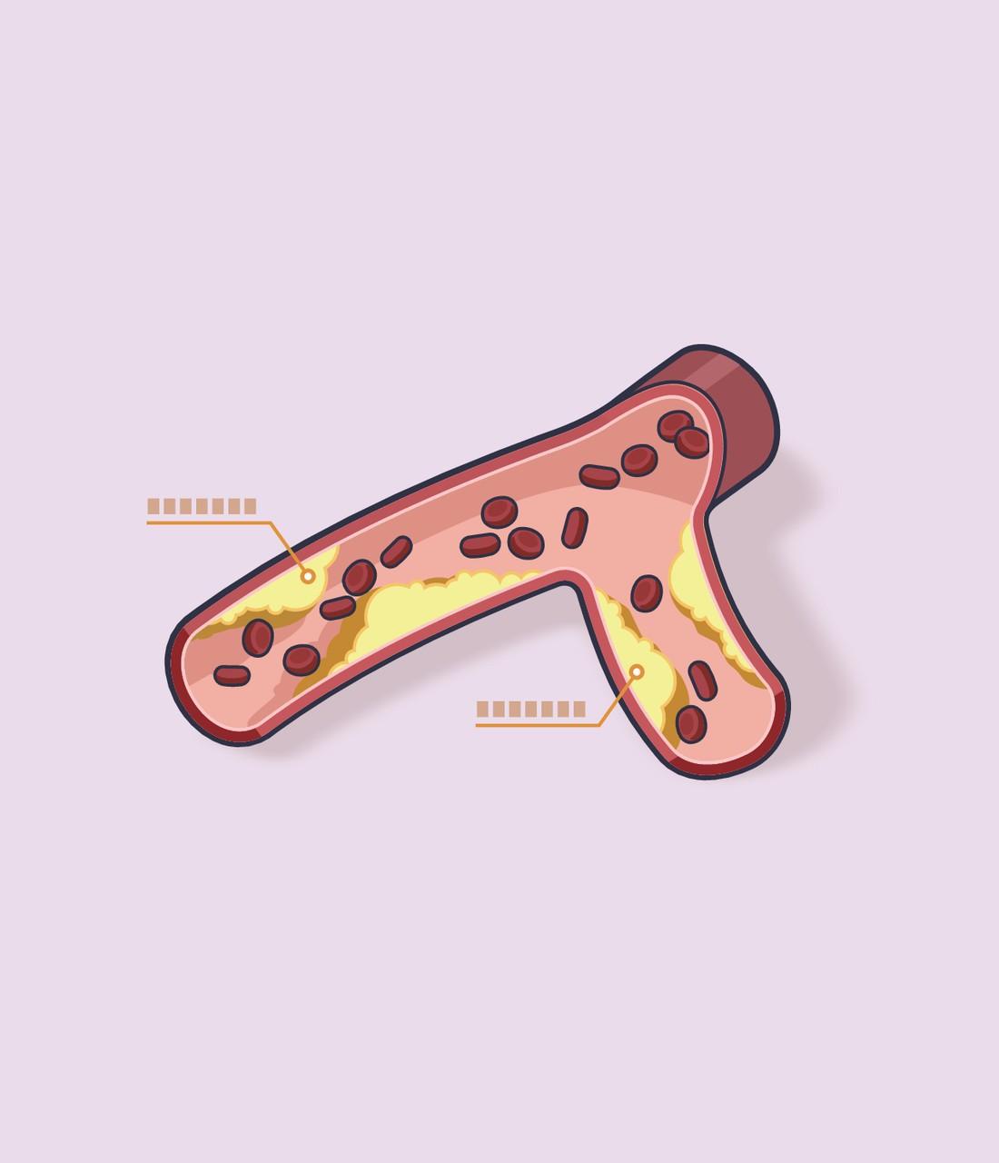 为什么越来越多的人出现血管堵塞?越来越多人出现血管堵塞，原因还挺多。就说睡眠不