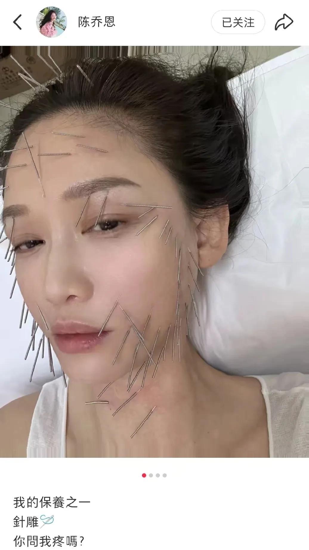 我的妈呀，这也太吓人了吧。看看陈乔恩，为了美，付出的代价，都快被扎成刺猬了。