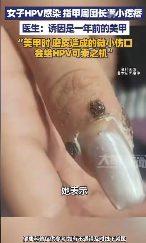 “太吓人了！”5月9日报道，浙江杭州，一女子发现她的指甲周边，长了许多粗糙坚硬的