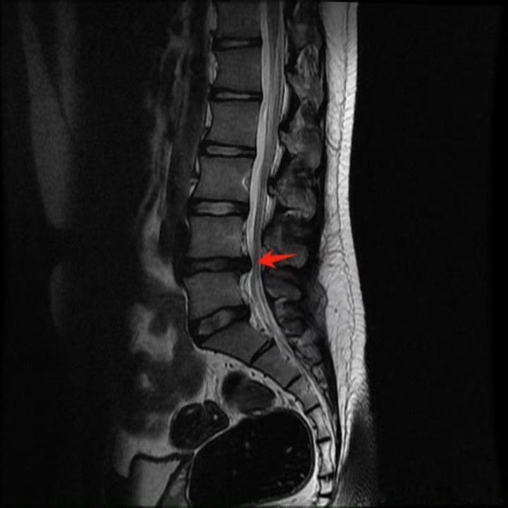 腰椎间盘突出【腰突总担心要手术?】这个话题,我在线下初诊或答疑中常常遇到,今天