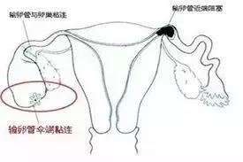 输卵管粘连, 还能好“孕”吗?