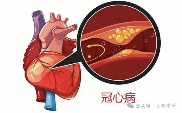 经方大家: 掌握这“四句话”, 冠心病3剂即可见效