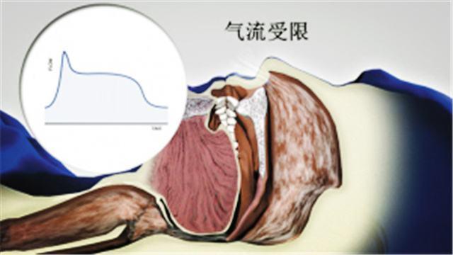 打呼噜是什么原因