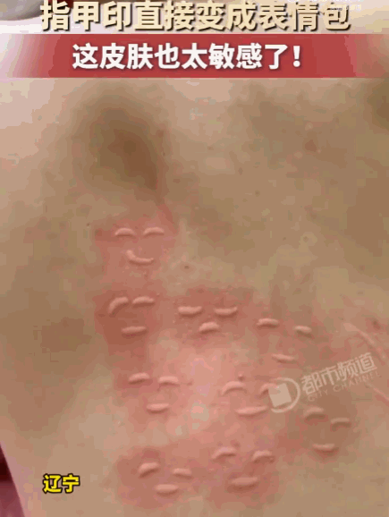 不可思议！辽宁，一男子因患有特殊的皮肤划痕症，后背竟成了“能画画的画板”。视频中
