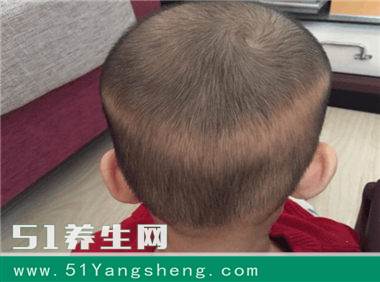 枕秃是不是缺钙, 枕秃跟缺钙到底有多大关系?