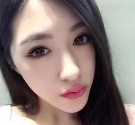 自体脂肪填充后脸上凹陷性疤痕被修复了