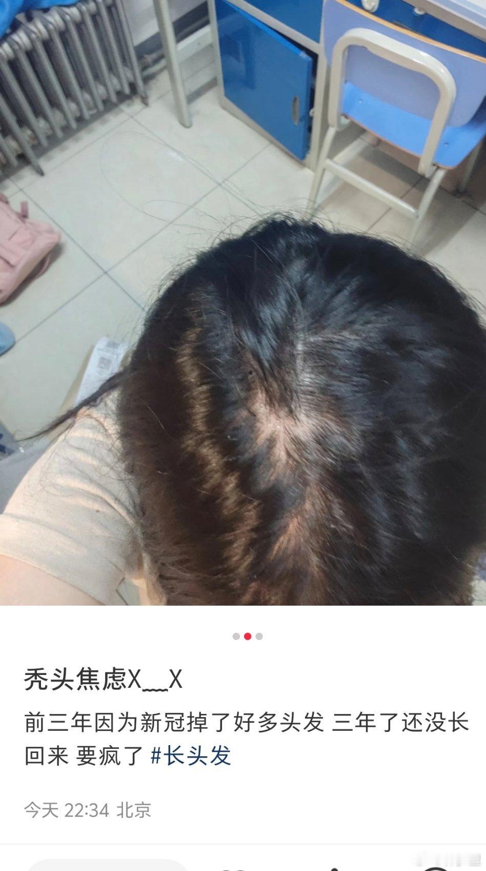 新冠后秃头，三年了还没长回来。​​​