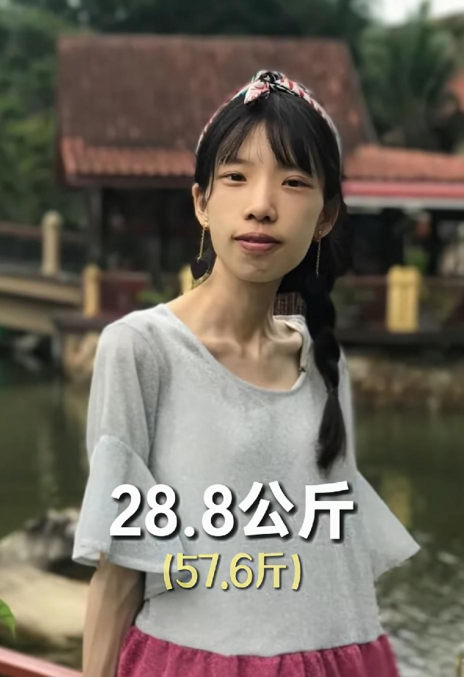 女孩因减肥过度，患上了厌食症，体重只有57.6斤，瘦的只剩下皮包骨，像个老太太。
