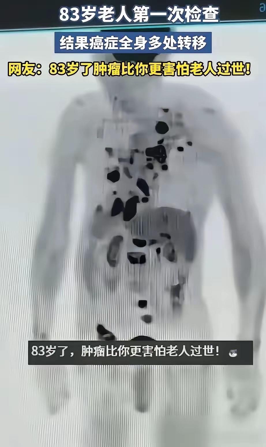 安徽一位83岁老人，生平第一次做全身检查，结果片子显示癌细胞已全身转移。可老人日