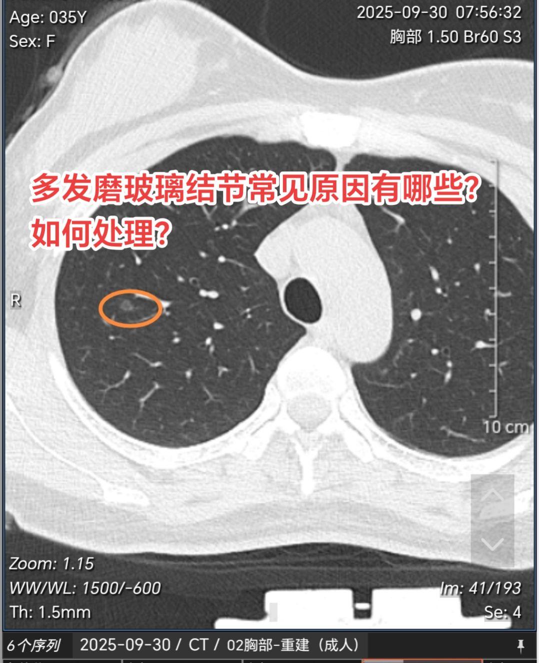 多发磨玻璃结节常见原因有哪些？如何处理？这种多发磨玻璃结节如果经半年左...
