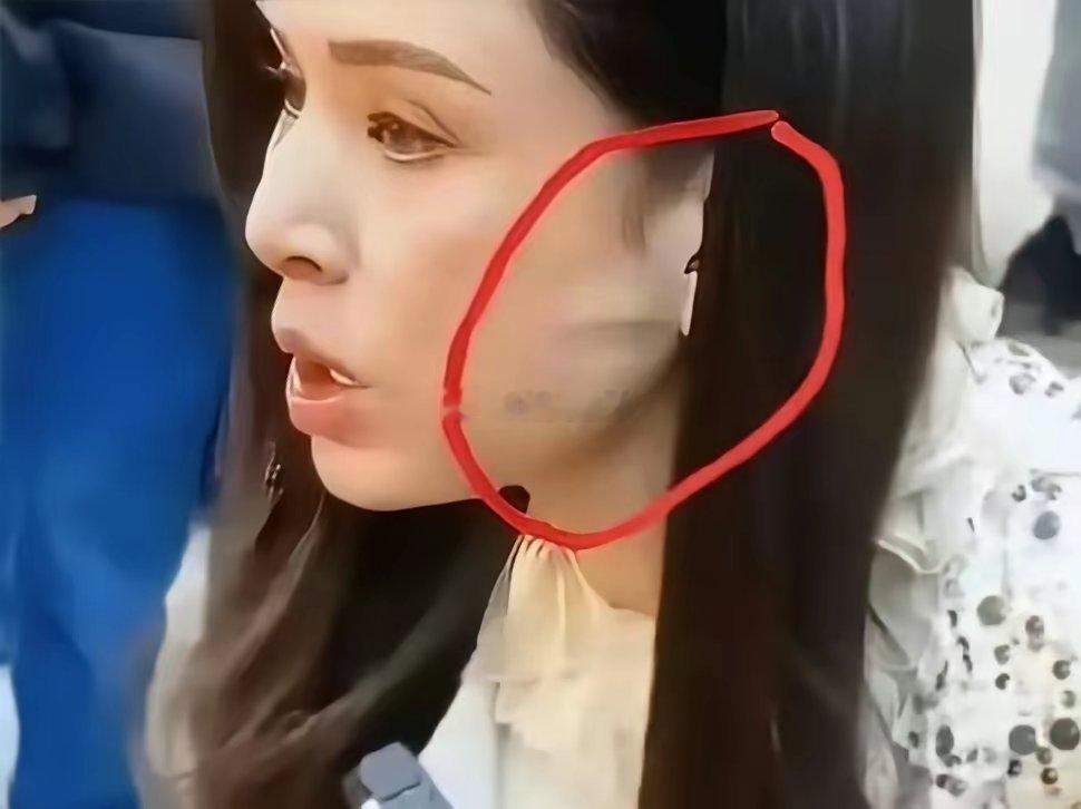 李若彤不是没有医美过吗？这耳前凸起的一条线是啥年纪大了皮肤松弛？
