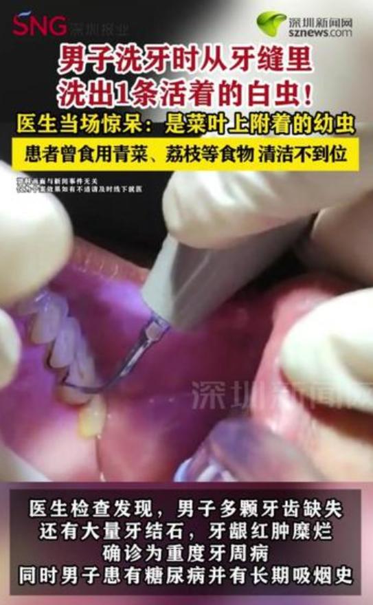 “头皮发麻！”7月9日报道，福建泉州，一男子不太注意口腔卫生，他假牙戴着很不舒服