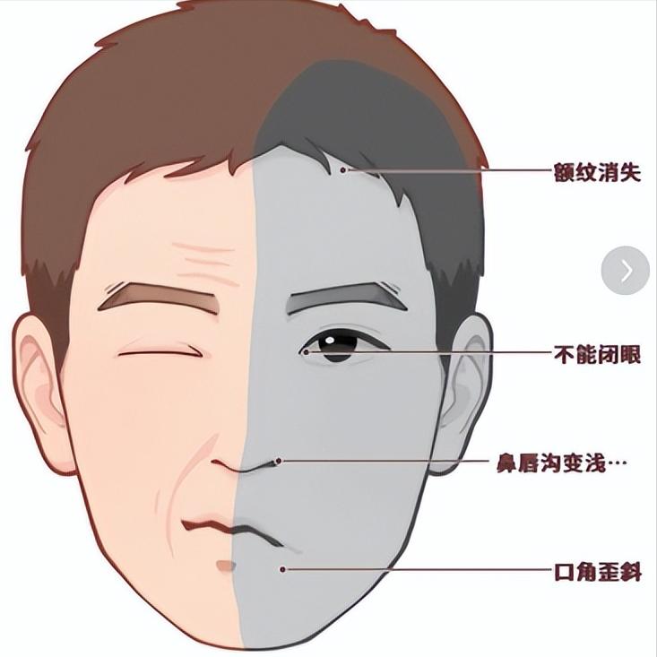 面神经损伤后还有机会吗？抓住“黄金窗口”，很多人可以更好老张面瘫半年了，针灸
